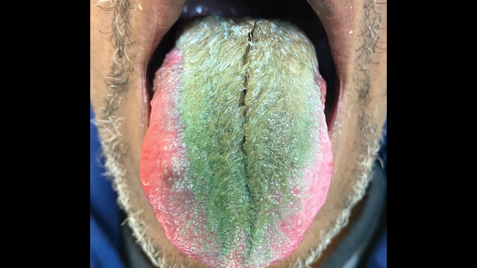 tobacco hairy tongue A 64-year-old smoker had a case of hairy green tongue