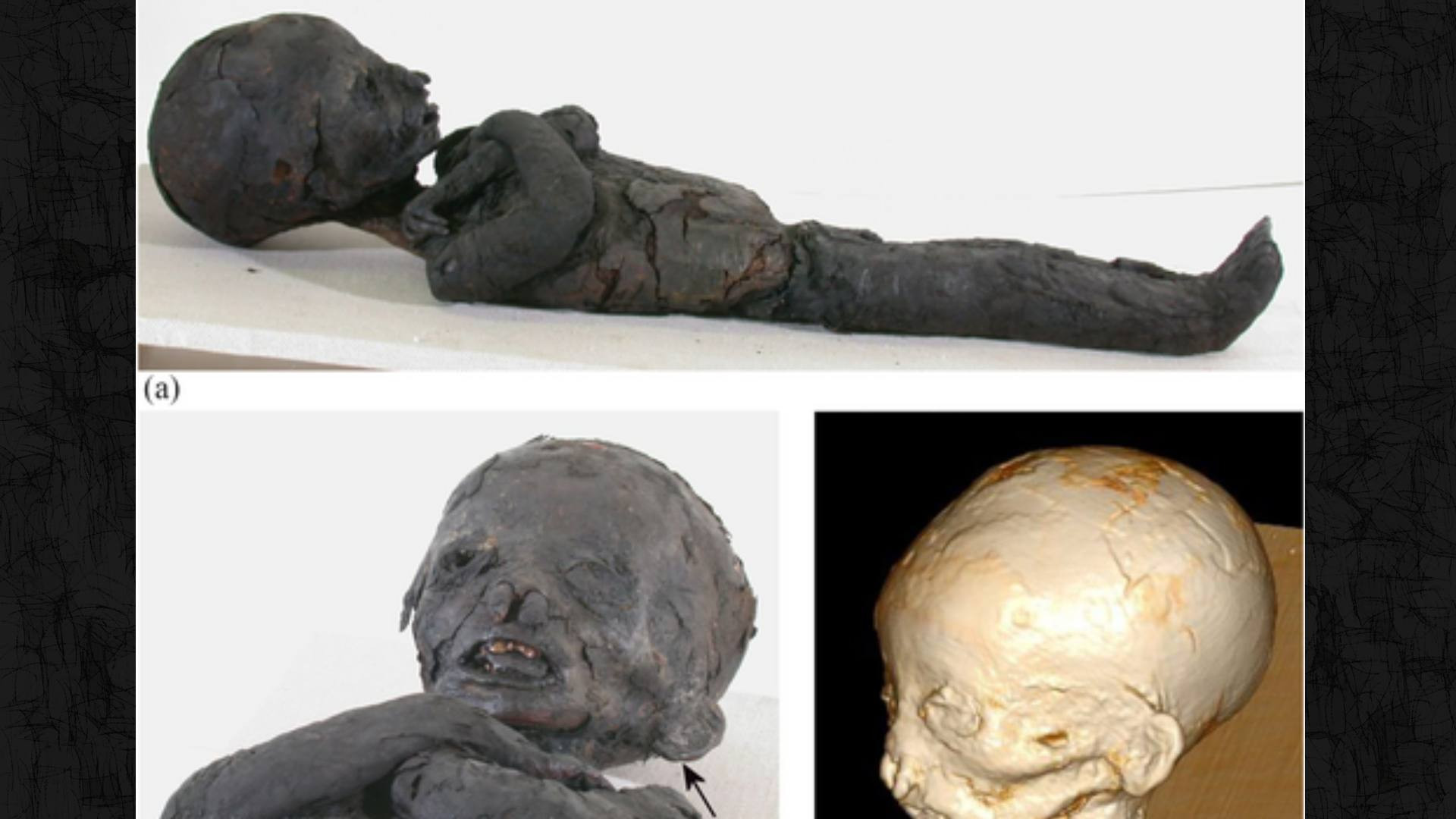 Mummies show anemia was common in ancient Egypt Mummies show anemia was common in ancient Egypt