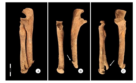 Archaeologists Find Skeleton of Medieval Man Who Used a Knife as a Prosthetic Limb Archaeologists Find Skeleton of Medieval Man Who Used a Knife as a Prosthetic Limb