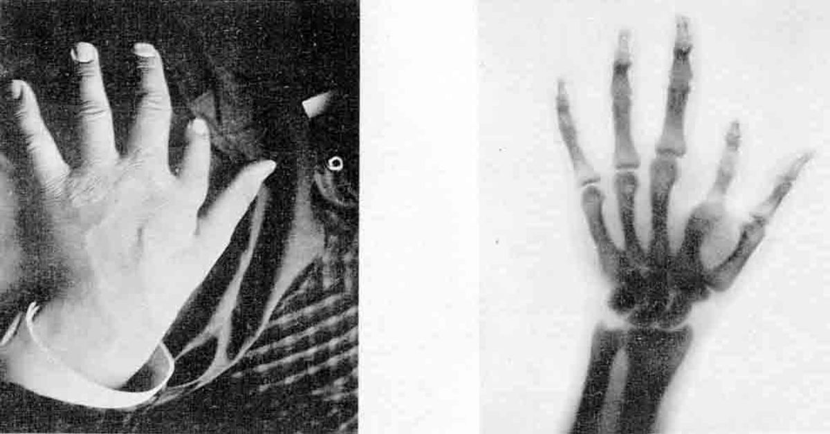 Everything You Need to Know About the X-Ray and Its Accidental History Everything You Need to Know About the X-Ray and Its Accidental History