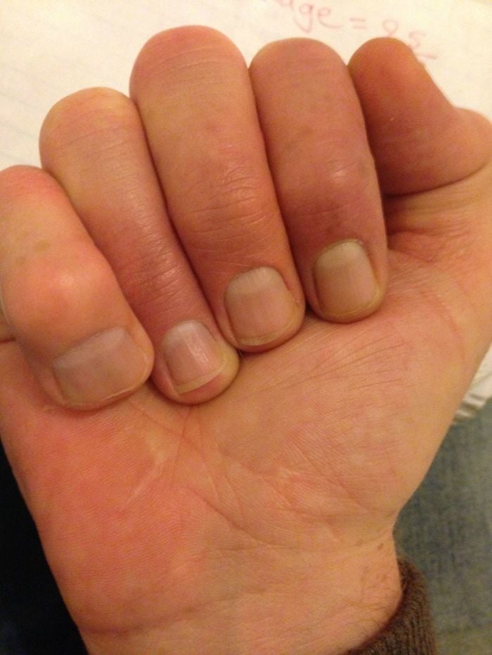 genetic conditions big fingers