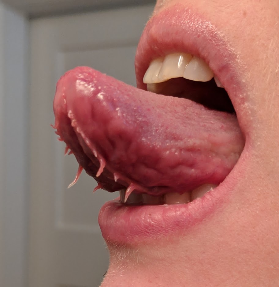 genetic conditions tongue